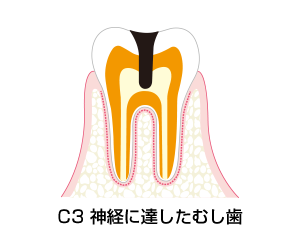 C3－神経に達したむし歯