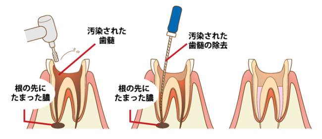 根管治療