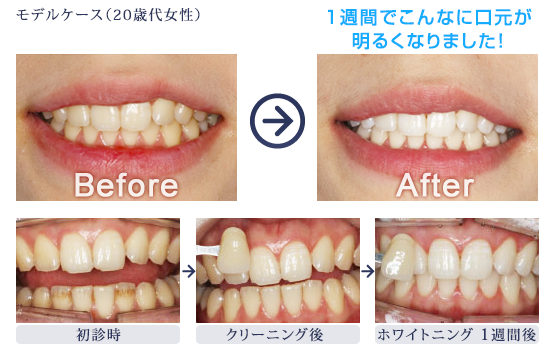 ホワイトニング | 診療内容 | 寒竹歯科医院｜稲毛海岸駅徒歩1分｜土日