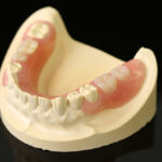 ノンクラスプ・デンチャー