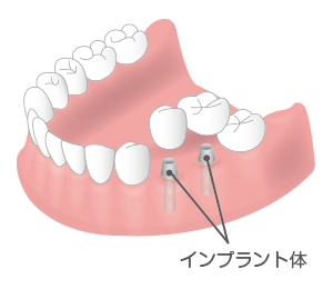 インプラント体