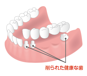 削られた健康な歯