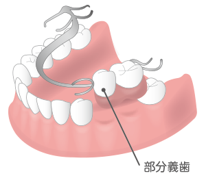 部分義歯