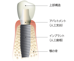 インプラントの構造