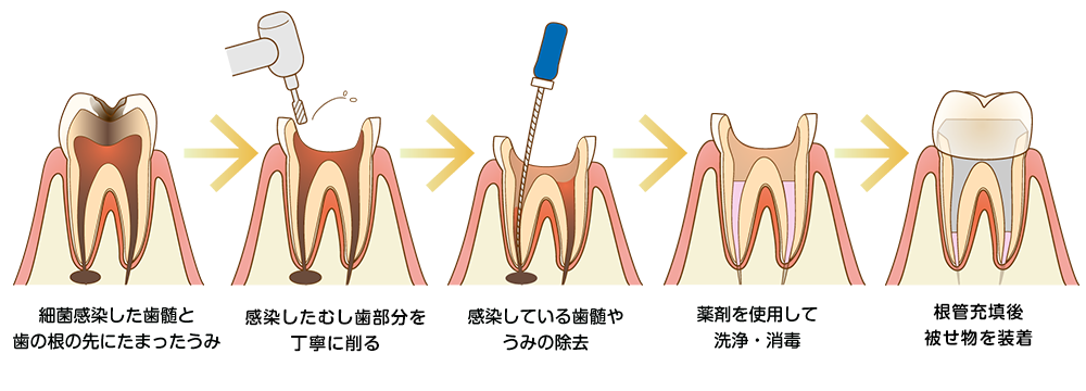 根管治療流れ