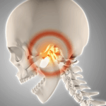 顎関関節症イメージ